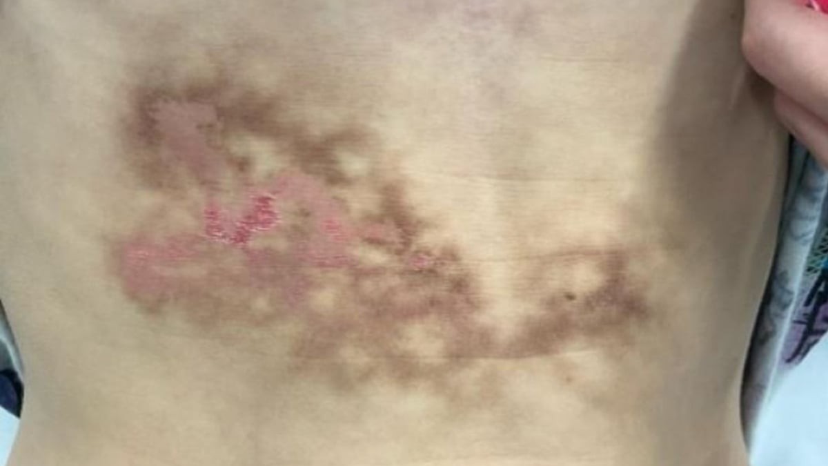 Laptop on Lap for Hours? Doctors Warn of 'Toasted Skin Syndrome'